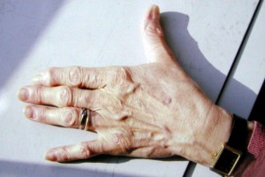 arthrose-des-mains