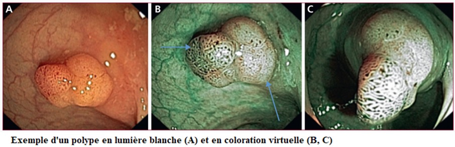 Coloscopie : endoscopie du colon et rectum - Hôpital Saint-Antoine ...
