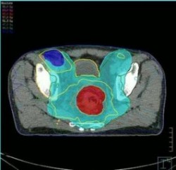 Dosimétrie IMRT d'une tumeur du canal anal