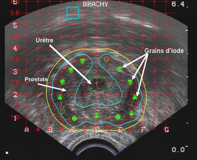 La curiethérapie RadiothérapieTenon