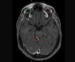 Image IRM d'une lésion cérébrale