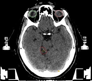 Image scanner d'une lésion cérébrale