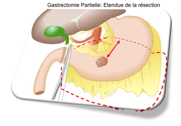 gastrectomie partielle