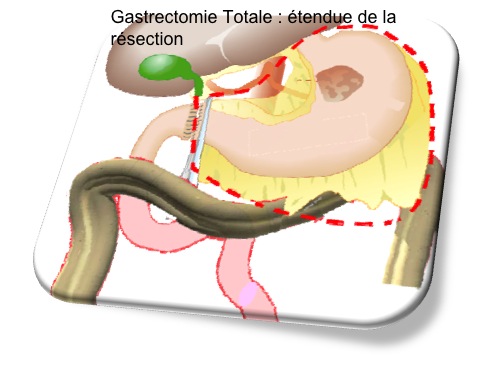 gastrectomie totale