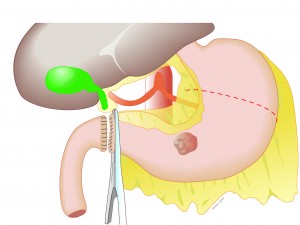 gastrectomie partielle